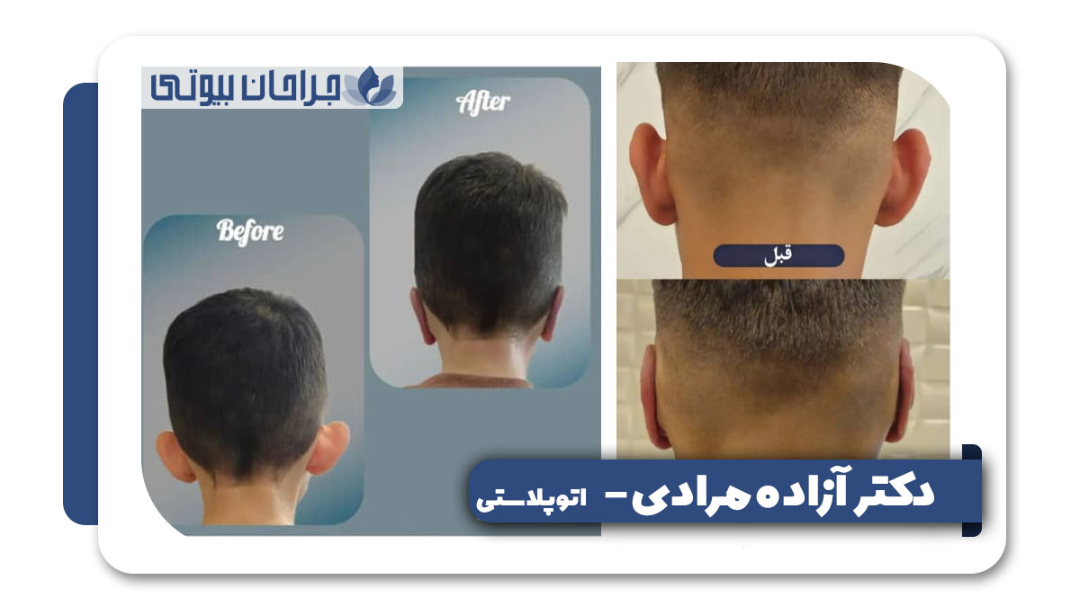 بهترین جراح اتوپلاستی در شیراز 
