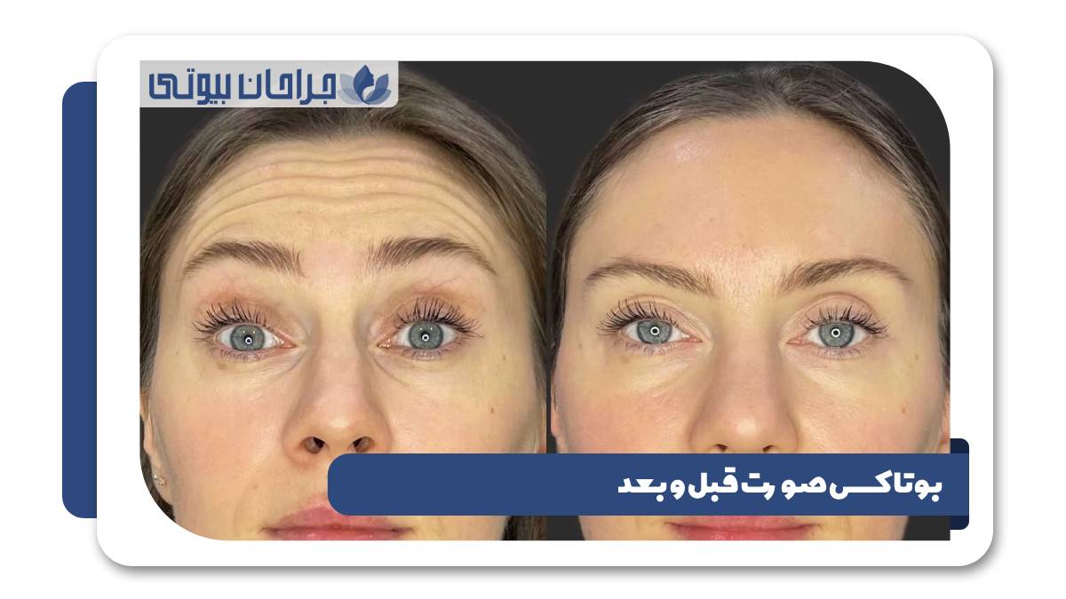 بوتاکس صورت قبل و بعد