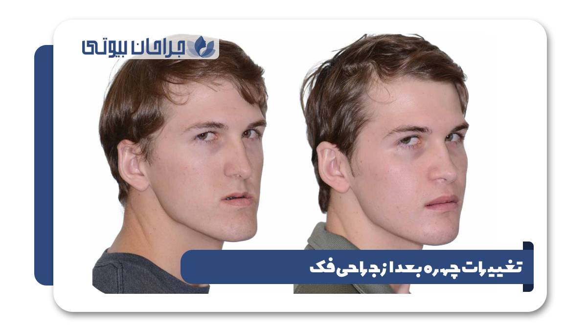 تغییرات چهره بعد از جراحی فک