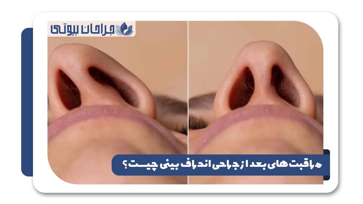 مراقبت های بعد از جراحی انحراف بینی چیست؟