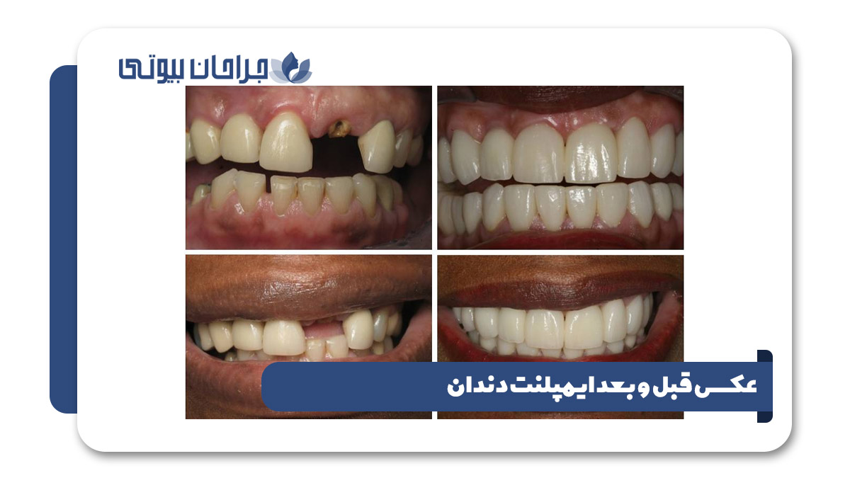 عکس قبل و بعد ایمپلنت دندان