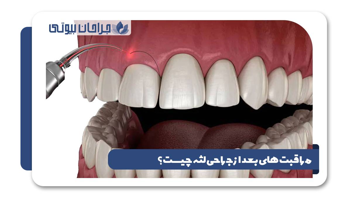 مراقبت های بعد از جراحی لثه چیست؟