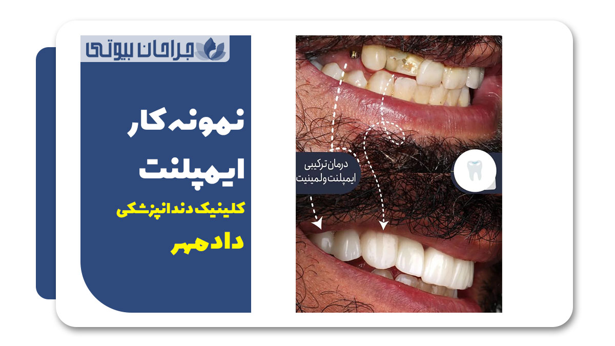 بهترین دکتر ایمپلنت در شیراز