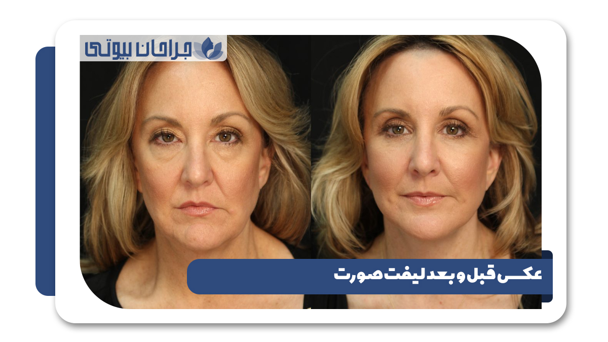 عکس قبل و بعد لیفت صورت