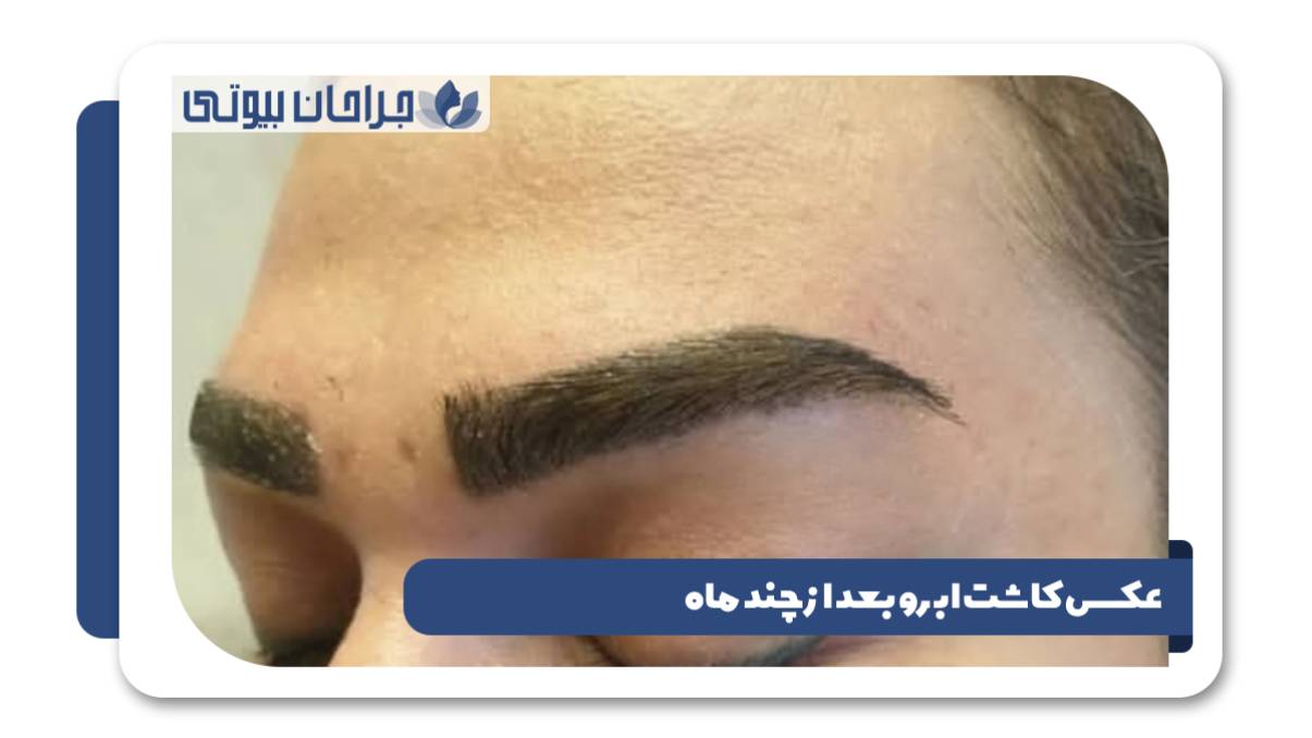 عکس کاشت ابرو بعد از چند ماه