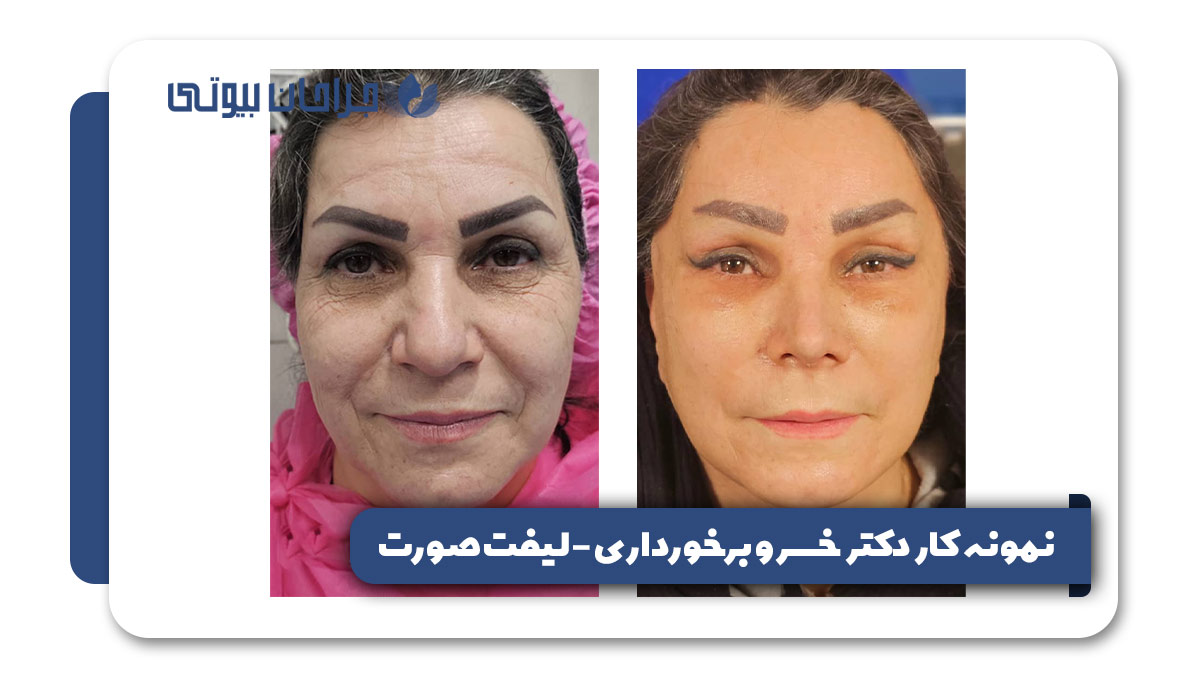 نمونه کار دکتر خسرو برخورداری - لیفت صورت