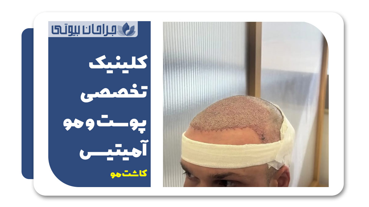 نمونه کار کلینیک کاشت مو در شیراز