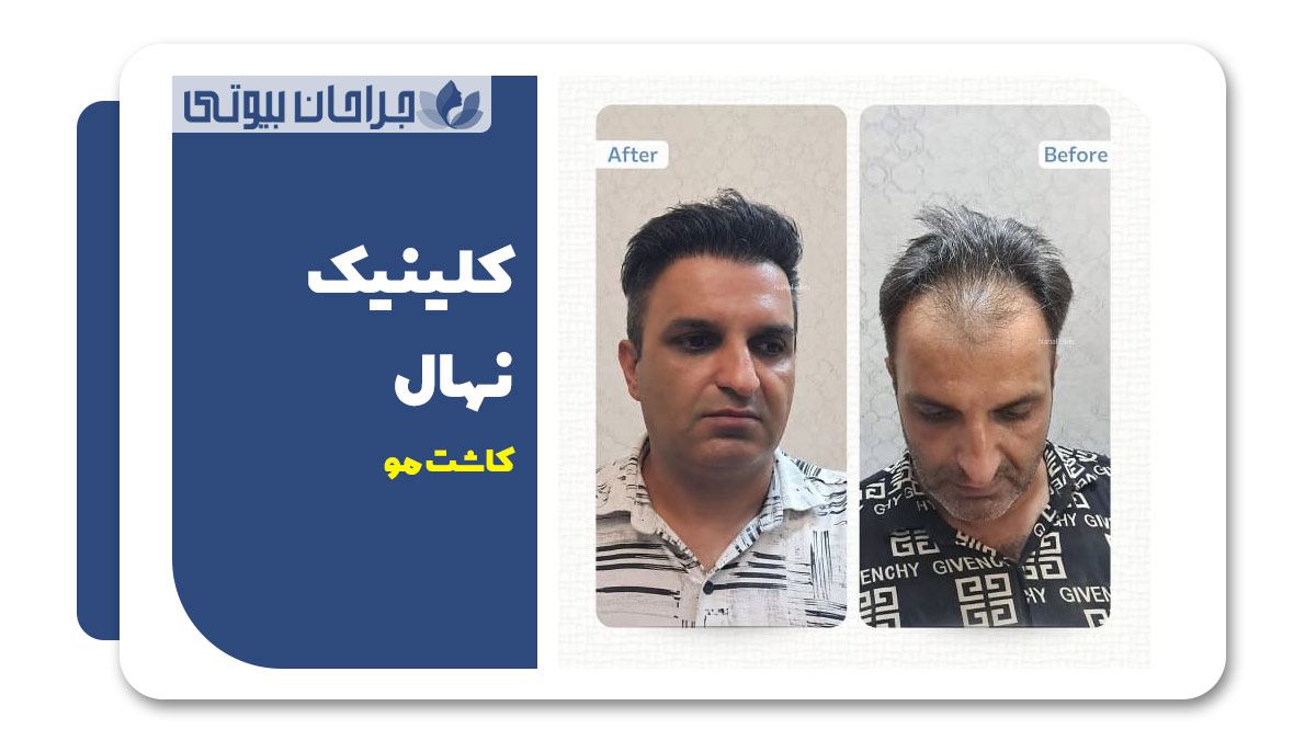 بهترین کلینیک کاشت مو در شیراز