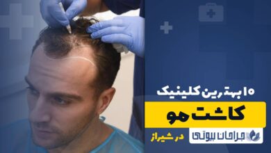 10 بهترین کلینیک کاشت مو در شیراز