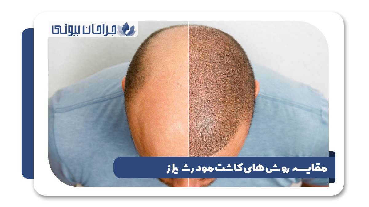 مقایسه روش های کاشت مو در شیراز