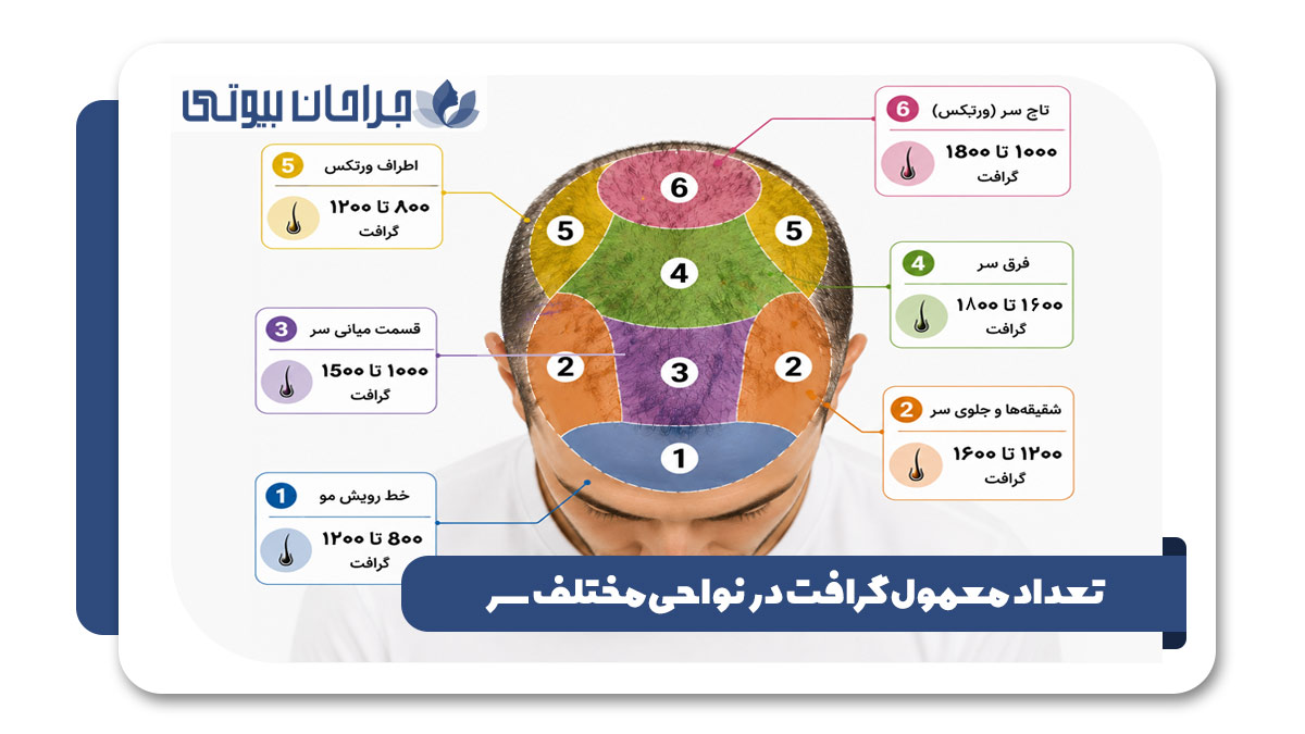 کلینیک کاشت مو در شیراز