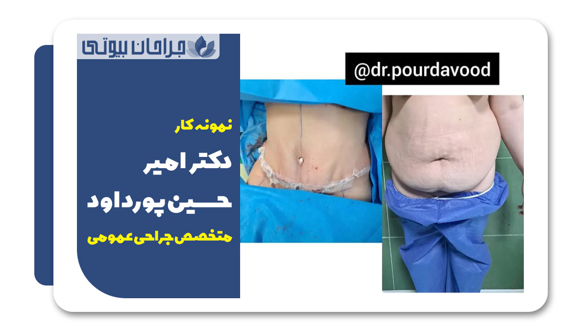 جراح ابدومینوپلاستی در شیراز 