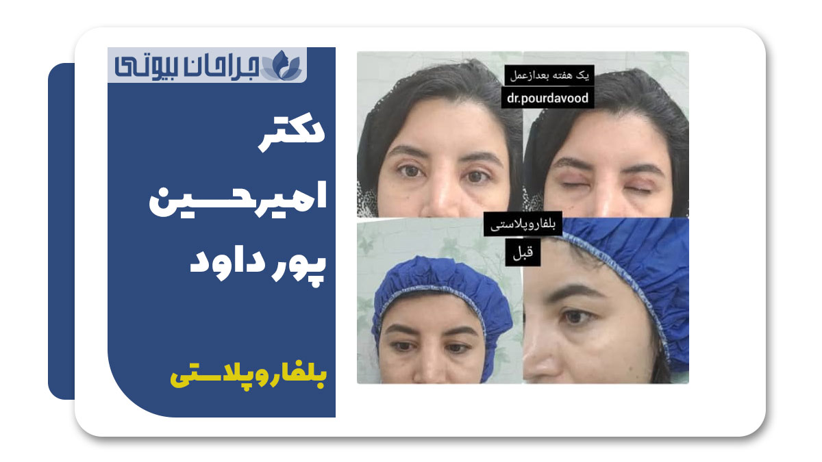 جراح بلفاروپلاستی در شیراز