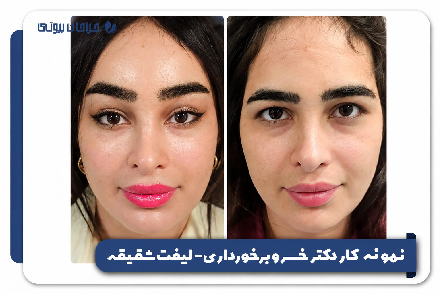 نمونه کار دکتر خسرو برخورداری - لیفت شقیقه