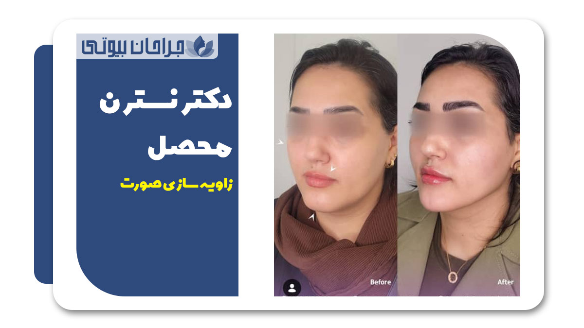 بهترین دکتر زاویه سازی صورت در شیراز