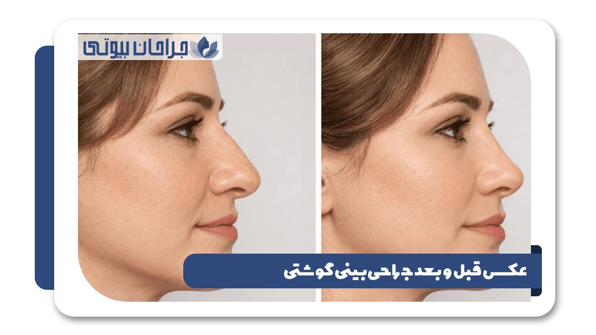 عکس قبل و بعد جراحی بینی گوشتی