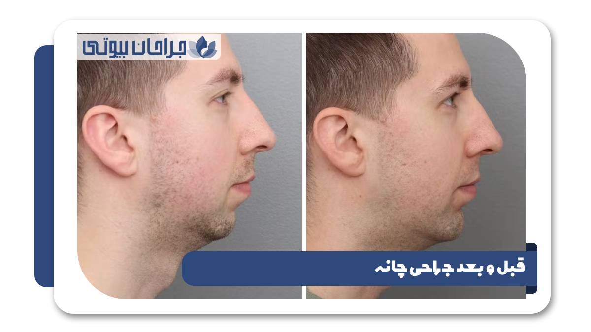 قبل و بعد جراحی چانه