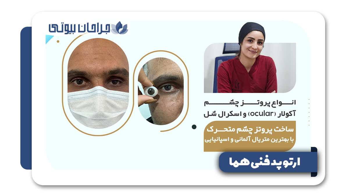 پروتز چشم در شیراز