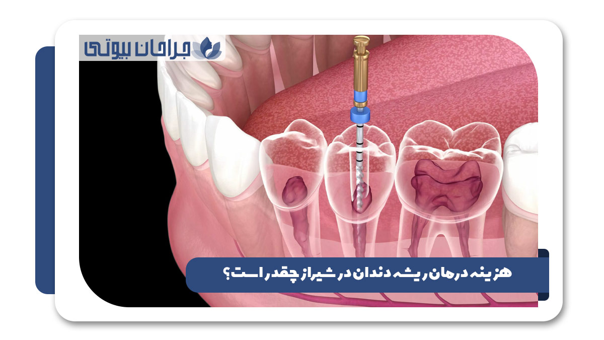 بهترین دکتر درمان ریشه دندان شیراز