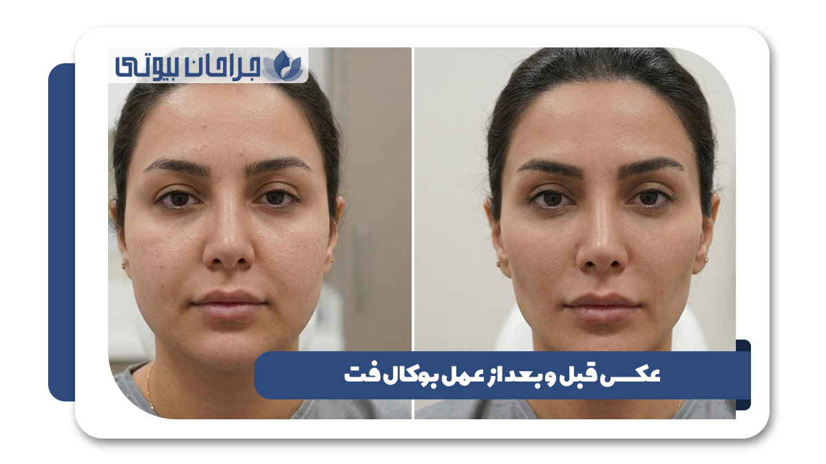 بهترین دکتر جراحی بوکال فت در شیراز