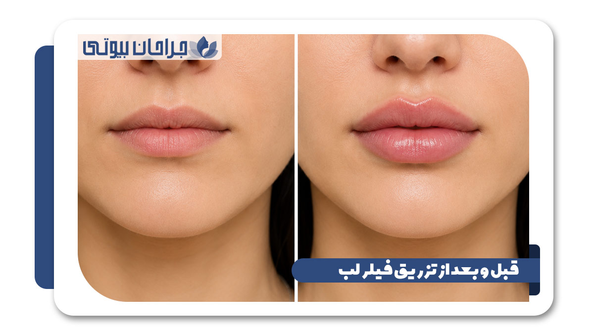 بهترین دکتر فیلر لب در شیرار
