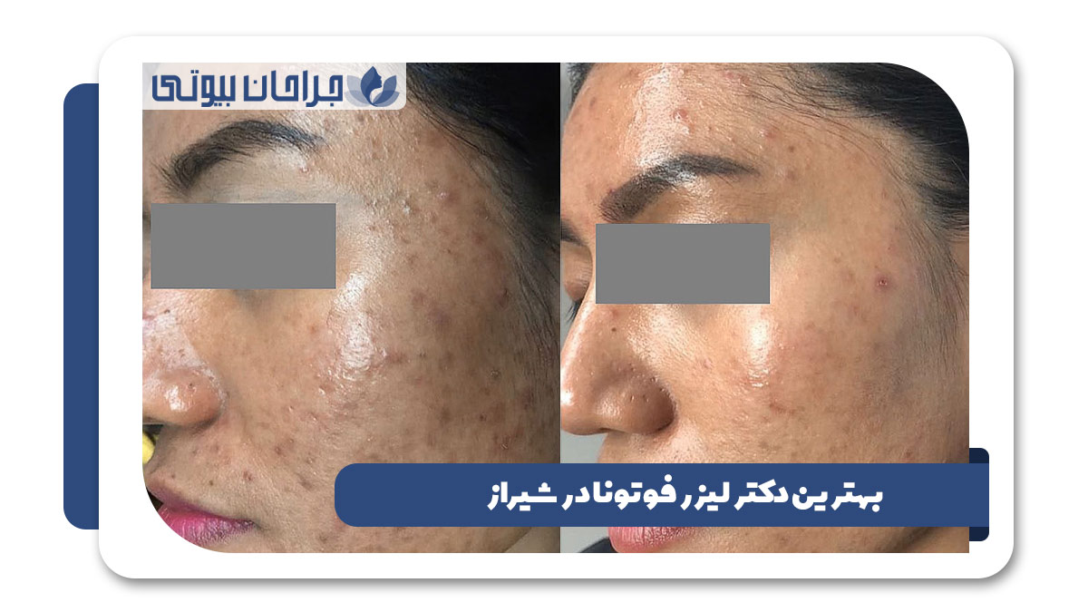 بهترین مرکز لیزر فوتونا در شیراز