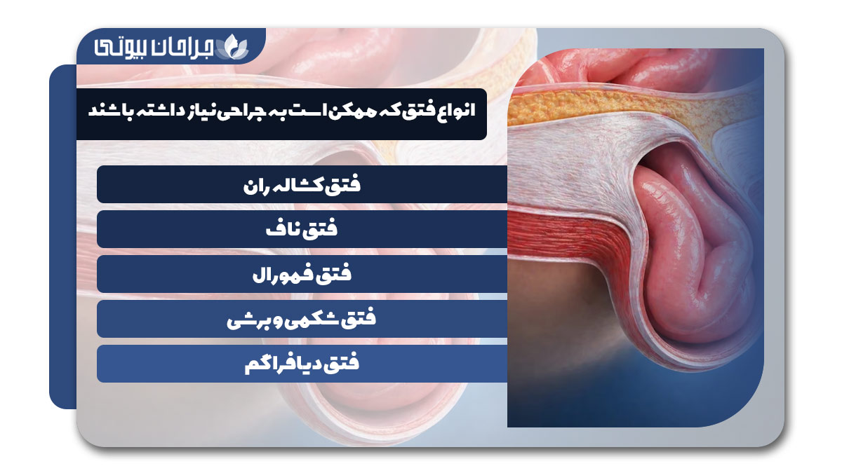 بهترین دکتر جراحی فتق در شیراز