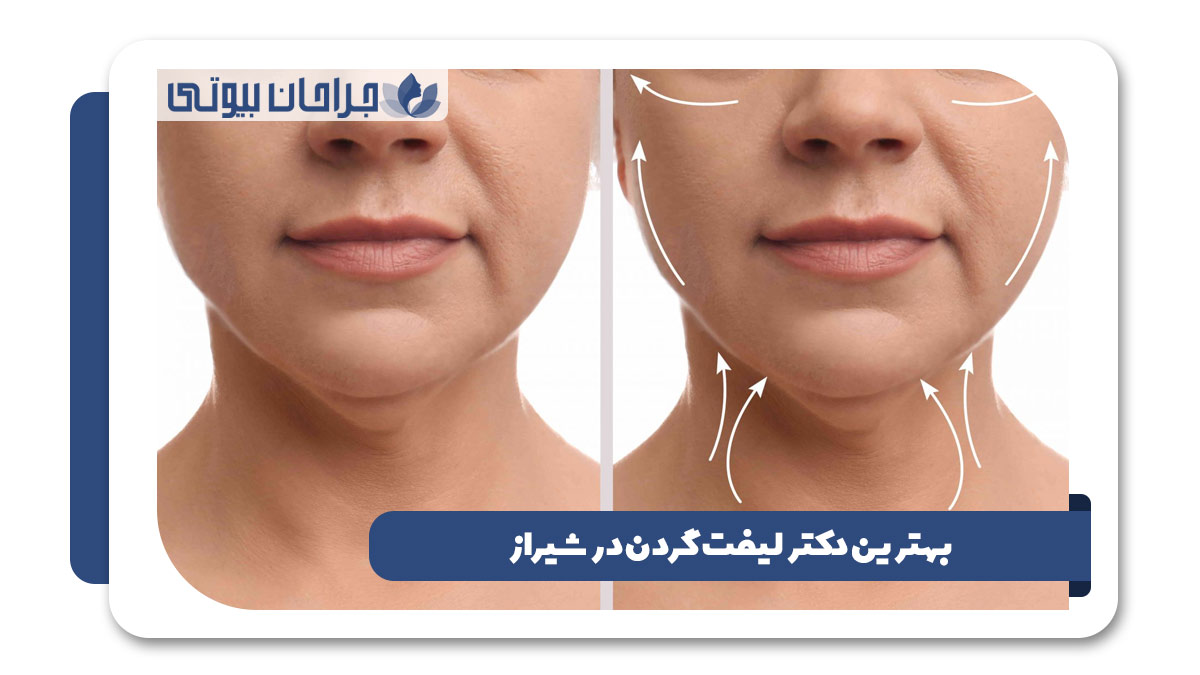 بهترین دکتر لیفت گردن در شیراز