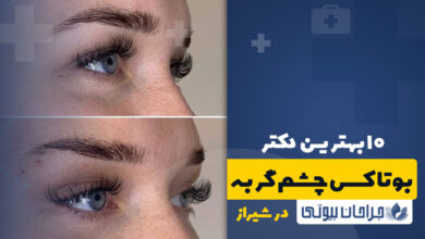 بوتاکس چشم گربه ای در شیراز