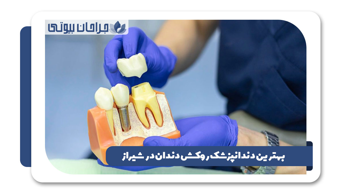 بهترین دکتر روکش دندان در شیراز
