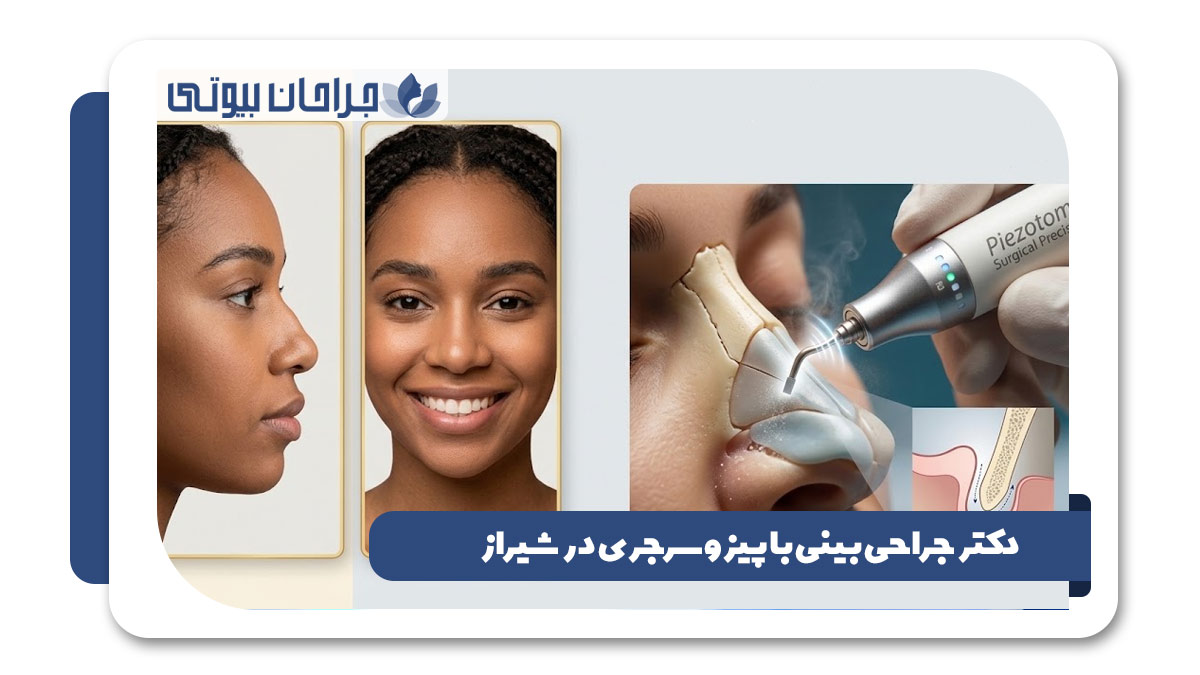 دکتر جراحی بینی با پیزوسرجری در شیراز