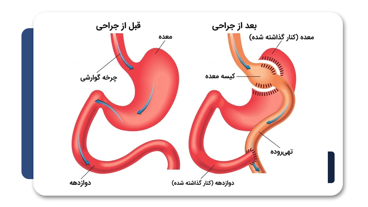 بهترین جراح بای پس معده در شیراز