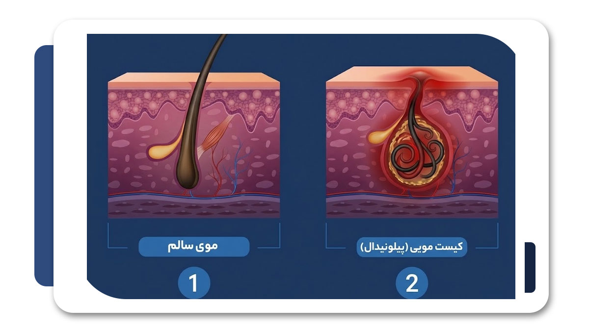 جراحی کیست مویی در شیراز