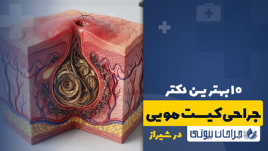 جراحی کیست مویی در شیراز